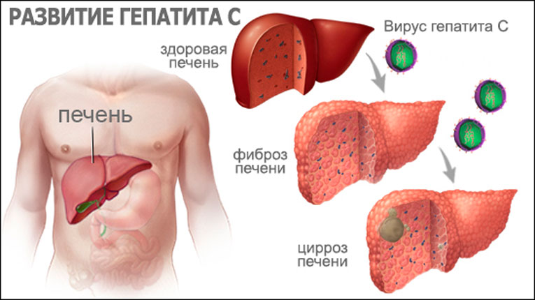 Как вылечить гепатит с переходом в цирроз печени?