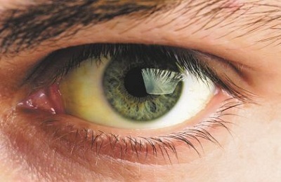 Боли в глазах и желтизна склер при гепатите