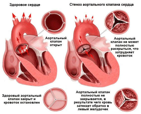 Патологии сердца