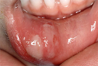 Повреждение губ