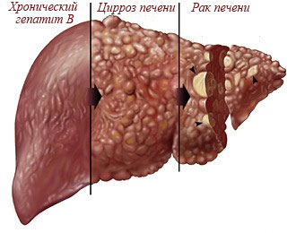 Почему гепатит приводит к раку печени и как он проявляется?