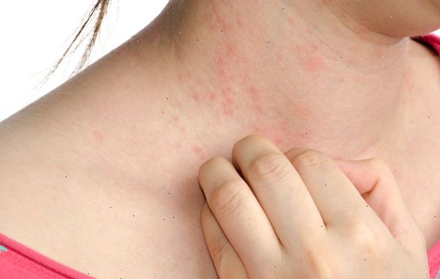 Сыпь и кожный зуд при гепатитах различных форм
