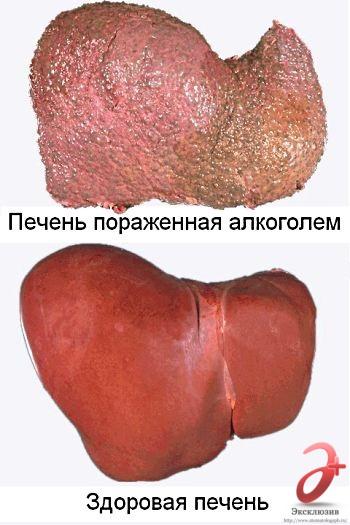 Лечение алкогольного гепатита и последствия для больного