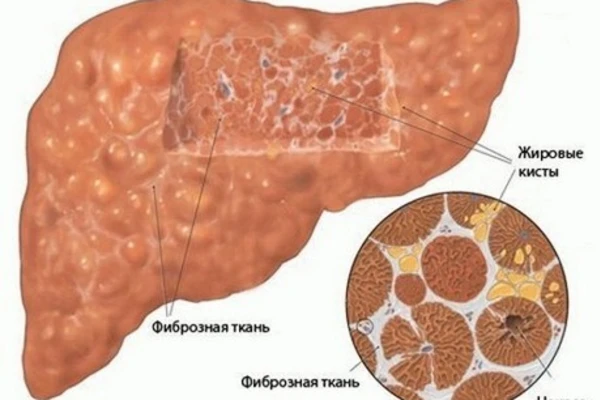 Что такое вторичный реактивный гепатит, его причины и лечение?
