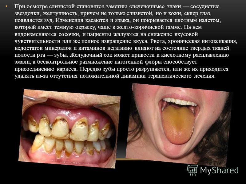 Состояние полости рта и языка при гепатите