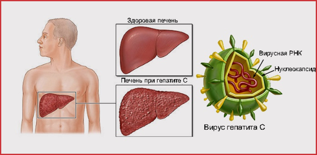 Болезнь гепатит С