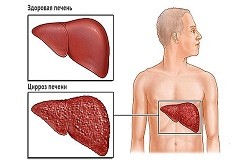 Вирусная нагрузка при заболевании гепатитом С