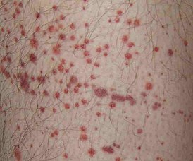 Сыпь при гепатите: причины и способы лечения