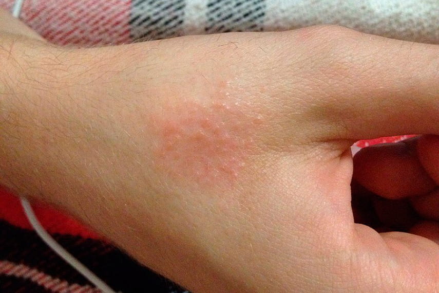 Сыпь на лице при гепатите 24