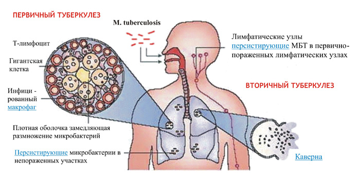 Механизмы возникновения туберкулеза